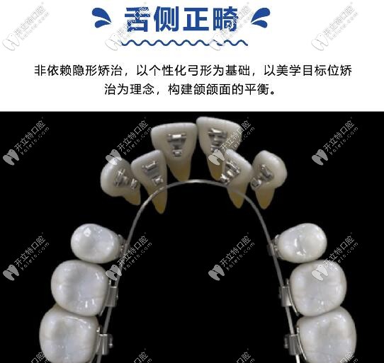 天津中瑛口腔舌側(cè)隱形矯正器