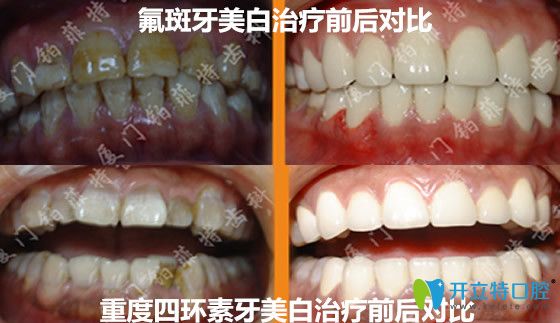 鉑菲特口腔氟斑牙+重度四環(huán)素牙美白治療前后對比案例