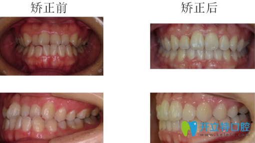 哈爾濱大象牙科牙齒隱形矯正前后正側(cè)面對比圖