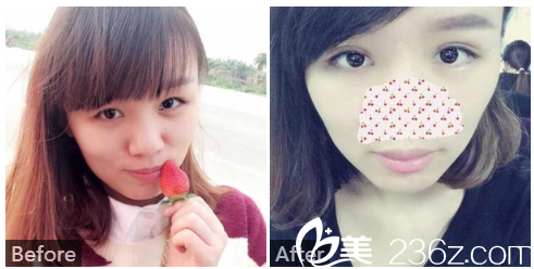 廣州中山醫(yī)科大學(xué)家庭醫(yī)生整形美容醫(yī)院聶云飛雙眼皮失敗修復(fù)案例圖