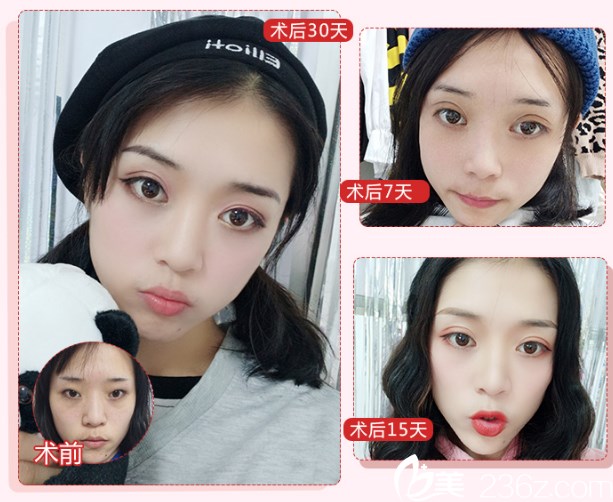 廣東畫美整形醫(yī)院牟北平雙眼皮案例