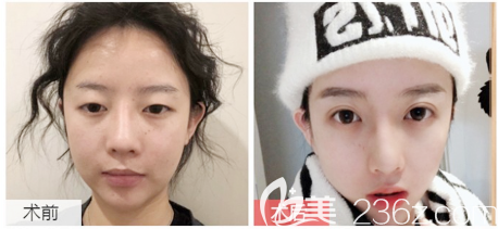 廣東畫美石林醫(yī)生雙眼皮案例