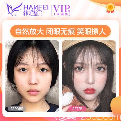 廣東廣州畫美曾繁茂做的雙眼皮案例