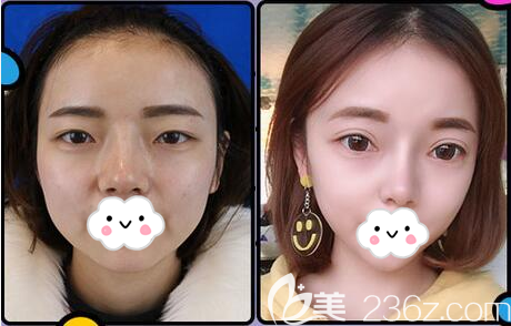 成都美立方任天平鼻綜合前后對(duì)比照