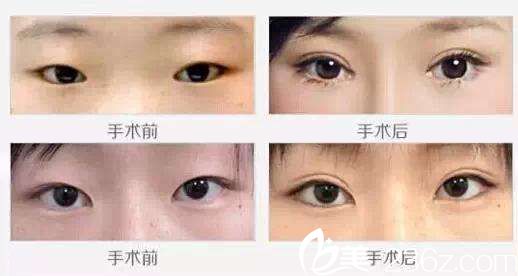 天津中心醫(yī)院整形與燒傷科雙眼皮案例