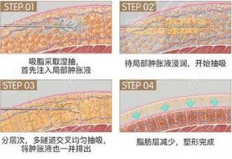 吸脂過(guò)程