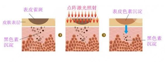 點(diǎn)陣激光原理