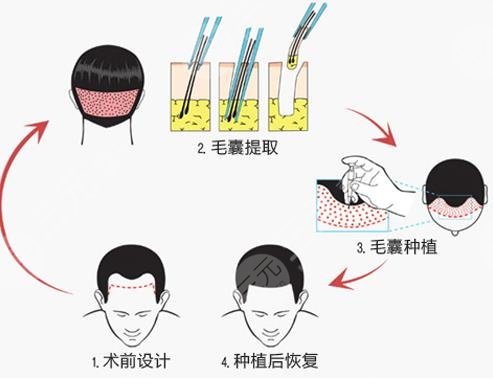 廣州植發(fā)的價格一般是多少