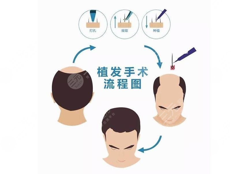 植發(fā)手術
