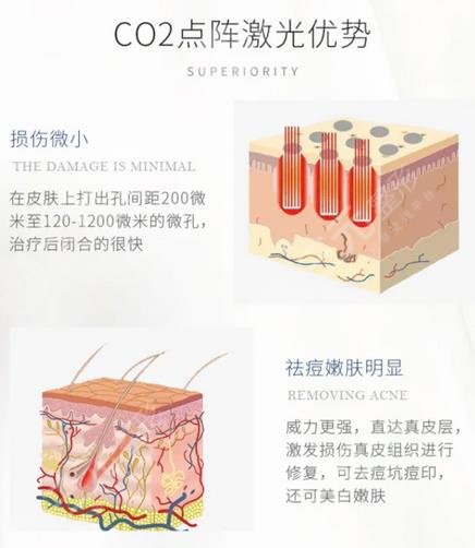 點陣激光