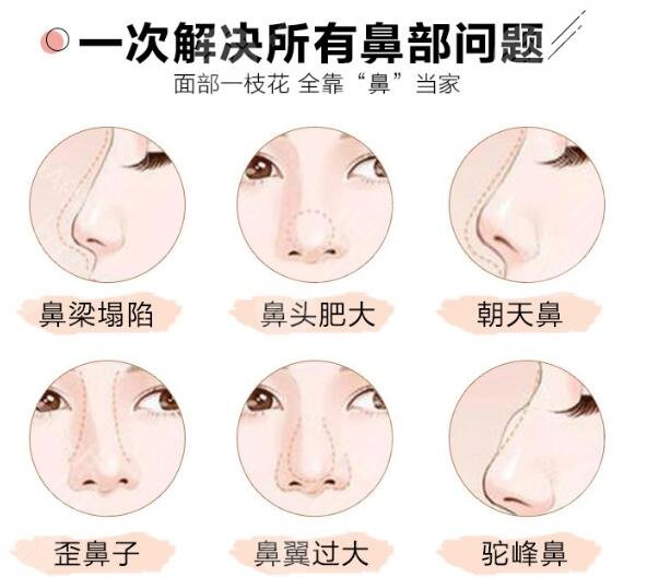假體隆鼻