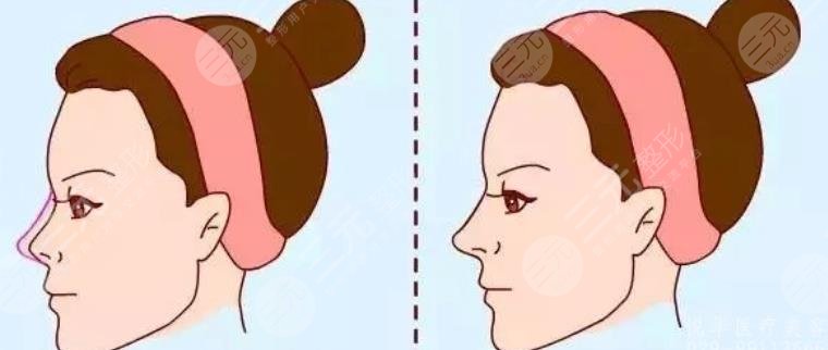 自體脂肪隆鼻