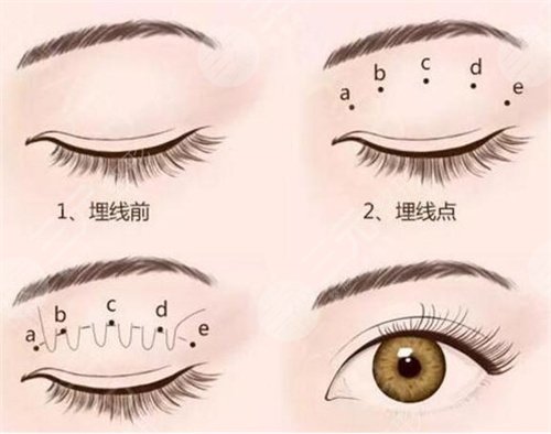 雙眼皮多項整形案例