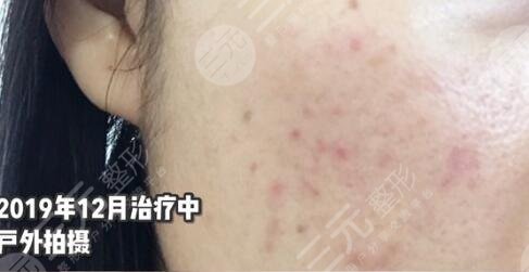 廈門中醫(yī)院皮膚美容科祛痘前