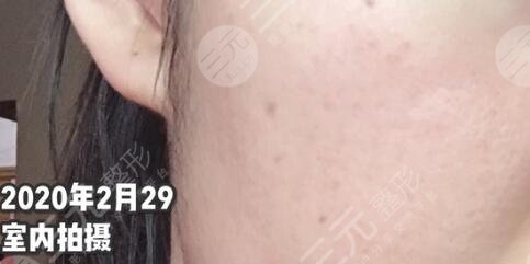 廈門中醫(yī)院皮膚美容科祛痘后
