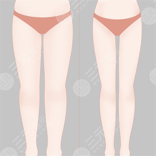 哈爾濱211醫(yī)院整形美容科大腿抽脂案例