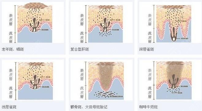 2025哈爾濱醫(yī)大一院激光祛斑案例果圖:術(shù)前