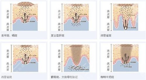 徐州第二人民醫(yī)院整形科激光祛斑圖