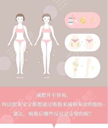 蘇州市立醫(yī)院腹部抽脂案例