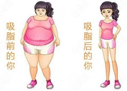 蘇州市立醫(yī)院腹部抽脂案例