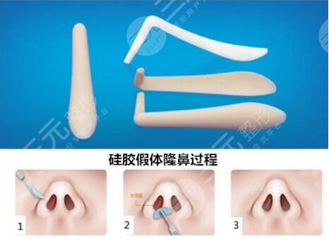 北京八大處整形科隆鼻案例