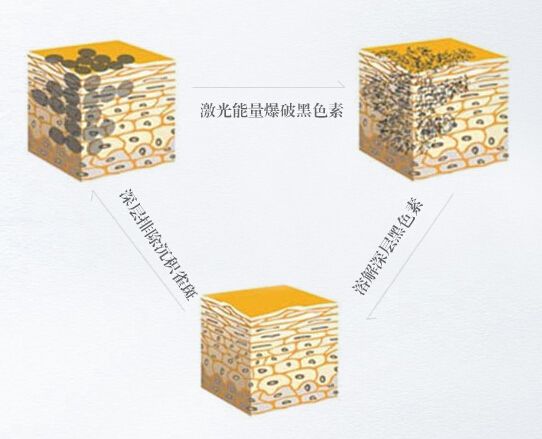 嘉興曙光醫(yī)院科普激光祛斑