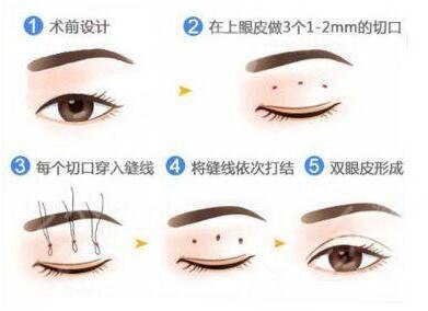 寧波113醫(yī)院整形科雙眼皮案例曝光