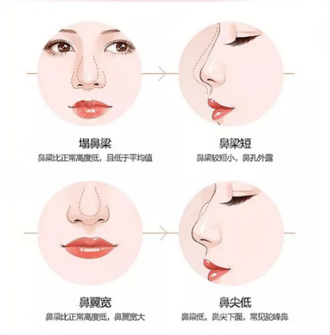 隆鼻果圖