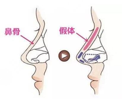 南京jur整形醫(yī)院正規(guī)嗎 好不好 失敗案例