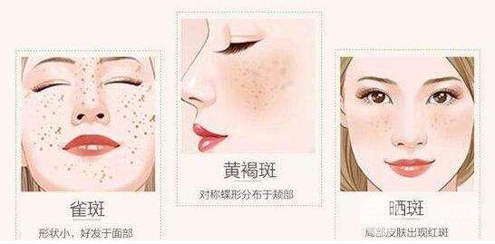 醫(yī)生講解雀斑是如何形成的?