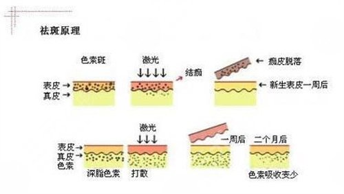 激光點痣