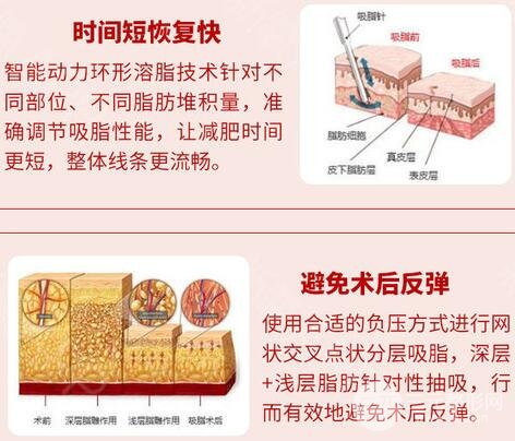吸脂減肥注意事項(xiàng)