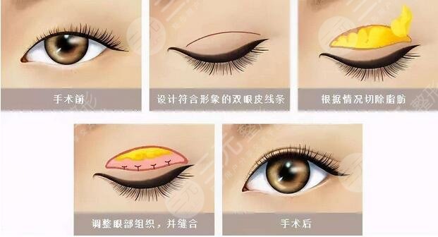 長春吉大二院美容科雙眼皮技術(shù)好不好