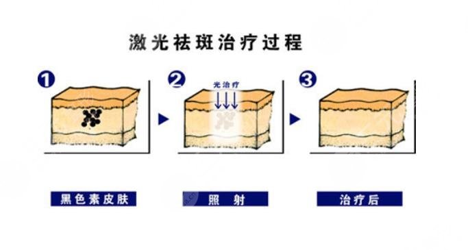 激光祛斑相關(guān)知識科普