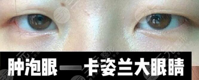 廈門第一醫(yī)院整形科雙眼皮術前