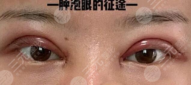 廈門第一醫(yī)院整形科雙眼皮術后一周
