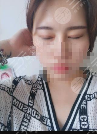 做雙眼皮手術(shù)之后