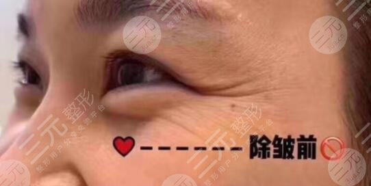面部年輕化案例前