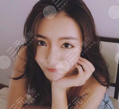石家莊美聯(lián)臣隆鼻案例