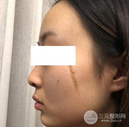 激光祛疤痕手術(shù)案例