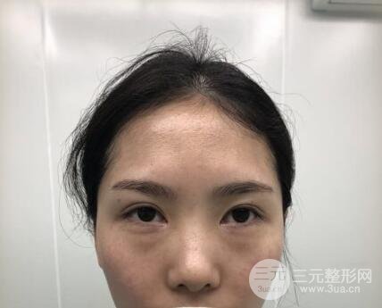祛眼袋手術(shù)案例