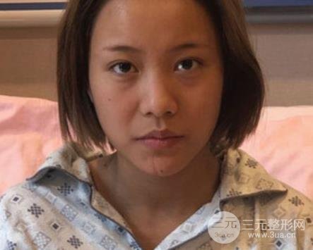 徐州二院整形科價格表更新&醫(yī)生名單&隆鼻案例~