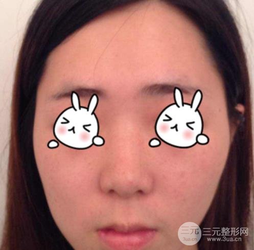 徐州二院整形科價格表更新&醫(yī)生名單&隆鼻案例~