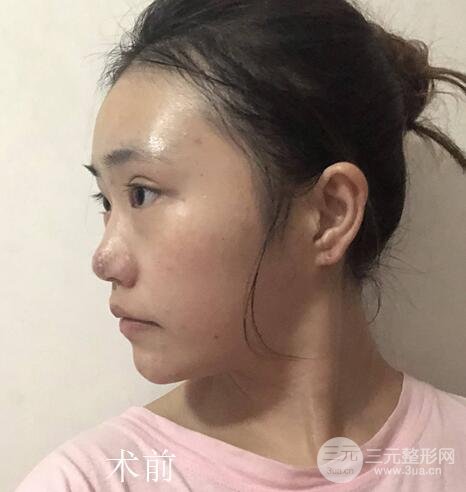 肋軟骨隆鼻案例