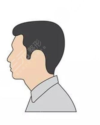 珠海雍禾植發(fā)醫(yī)院禿頂加密種植案例