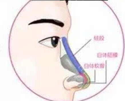 杭州隆鼻醫(yī)生張龍