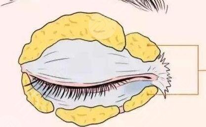 成都劉輔容雙眼皮修復到底怎么樣？和大家分享一波劉輔容眼修復案例